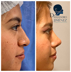 Rinoplastia estetica y funcional