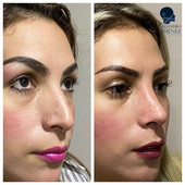 Rinoplastia estetica y funcional