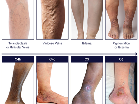 Understanding the Underlying Causes of Leg Discomfort: Recognizing Chronic Venous Insufficiency