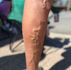 Vein Wellness: Key Risk Factors and Preventative Measures for Varicose Veins