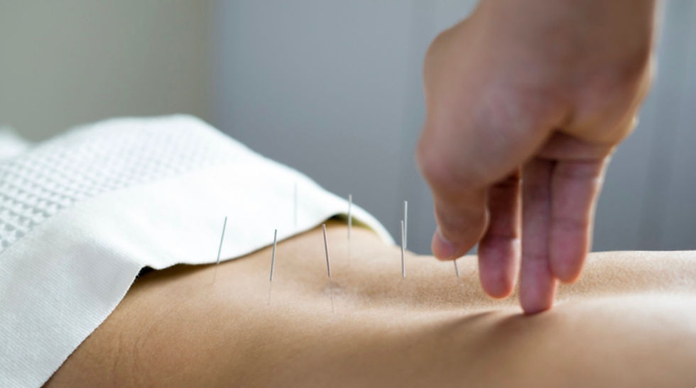 Close-up view of acupuncture needles inserted into a patient's back