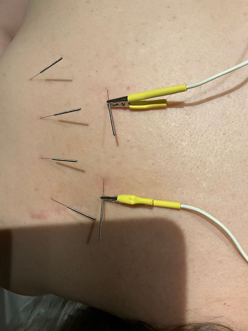 Close-up view of acupuncture needles inserted on a patient’s arm during a calming session