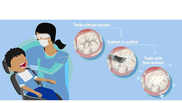 Tooth Sealant
