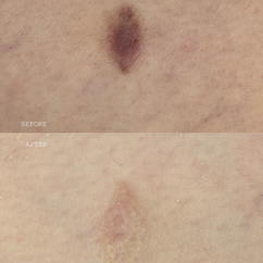 Medical camouflage tattoo, also known as scar camouflage, is a unique method to hide scars and stretch marks, learn online or in-person courses / training at Camo Academy