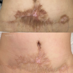 Medical camouflage tattoo, also known as scar camouflage, is a unique method to hide scars and stretch marks, learn online or in-person courses / training at Camo Academy