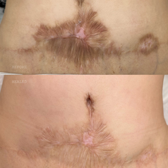Medical camouflage tattoo, also known as scar camouflage, is a unique method to hide scars and stretch marks, learn online or in-person courses / training at Camo Academy
