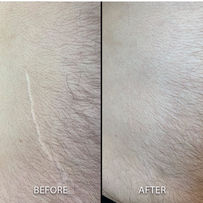 Camo Academy results using Exclusive Paramedical tattoo technique by Leticia Marcelino -  Scar Camouflage tattoo brings a permanent cover result for scars, stretch marks and vitiligo. Learn Scar Camouflage tattoo also know as Paramedical Tattoo Specialization online or in person with Camo Academy and Leticia Marcelino