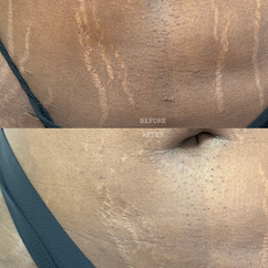 Medical camouflage tattoo, also known as scar camouflage, is a unique method to hide scars and stretch marks, learn online or in-person courses / training at Camo Academy