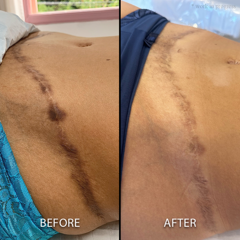 Advanced color Theory for Paramedical Tattoo training - The best Paramedical tattoo training, Leticia Marcelino exclusive Scar camouflage technique for perfect matching at Camo Academy Take your specialization in Paramedical tattoo known as Medical Camouflage tattoo training - Learn how to do Brazilian Camouflage tattoo with our Elite training. Learn ink chemistry for skin tone tattoo tones. Top Application techniques for scar lightening