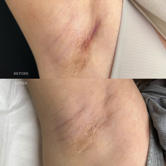 Medical camouflage tattoo, also known as scar camouflage, is a unique method to hide scars and stretch marks, learn online or in-person courses / training at Camo Academy