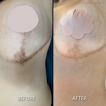 Advanced color Theory for Paramedical Tattoo training - The best Paramedical tattoo training, Leticia Marcelino exclusive Scar camouflage technique for perfect matching at Camo Academy Take your specialization in Paramedical tattoo known as Medical Camouflage tattoo training - Learn how to do Brazilian Camouflage tattoo with our Elite training. Learn ink chemistry for skin tone tattoo tones. Vip 1:1 trainings Advanced color theory for Every skin tone and undertone. Understand ink chemistry and how colors fade Learn how to work with freedom and confidence