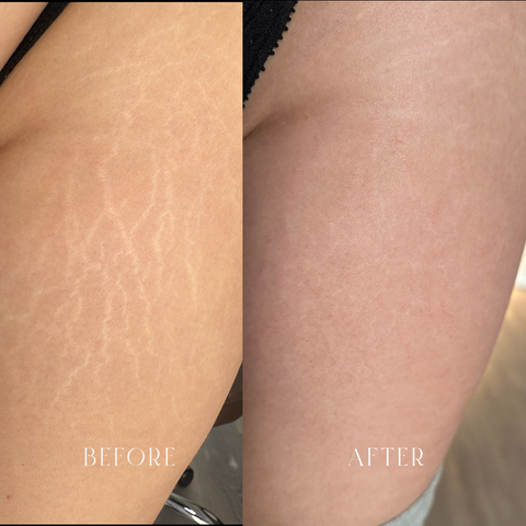 Stretch marks cover up solution to permanently hide stretch blending it with your skin tone. This Paramedical tattoo technique by Leticia Marcelino is a unique solution a treatment for stretch marks, Pregnancy stretch marks treatment, butt stretch marks solution, arms stretch marks treatment,  belly stretch marks solution. Stretch Mark Camouflage Tattoo also know as Brazilian Camouflage tattoo - results before and after for Medical Camouflage
