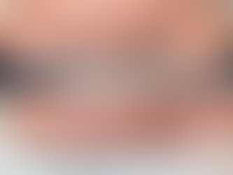 What is scar camouflage?