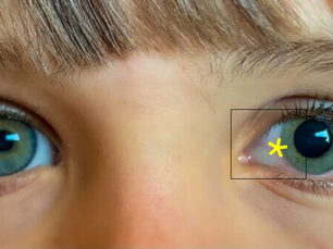 Low Dose Atropine (LDA) and the recent MHRA approval