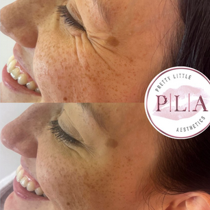 Crows feet anti wrinkle Wigan