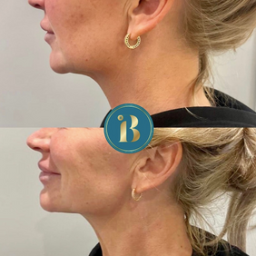 Chin filler Liverpool