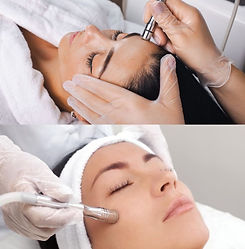 microdermabrasion