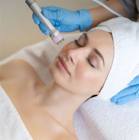 Radio frequency microneedling St Austell Cornwall