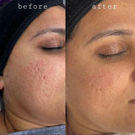 acne treatment Greenwich London