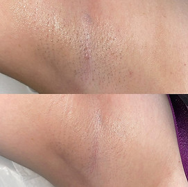 Diode Laser Hair Removal Wolverhampton