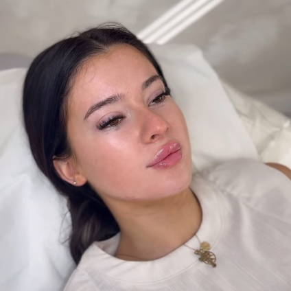 dermal fillers coventry