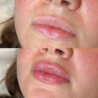 lip filler Greenwich London