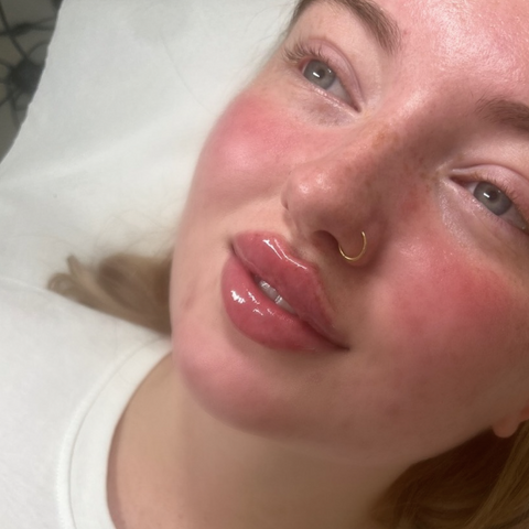 lip filler coventry