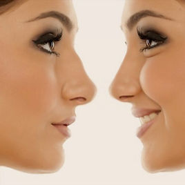 Non surgical rhinoplasty shoreham-by-sea