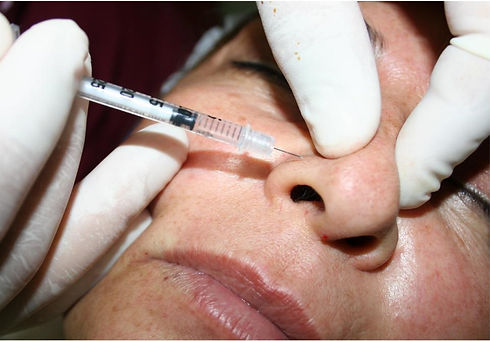 Nasal Flare Anti Wrinkle Injections London