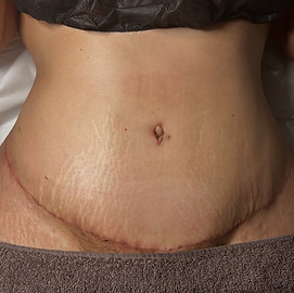 Post op lymphatic drainage wolverhampton