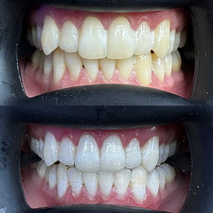 Teeth whitening Ashton under lyne manchester