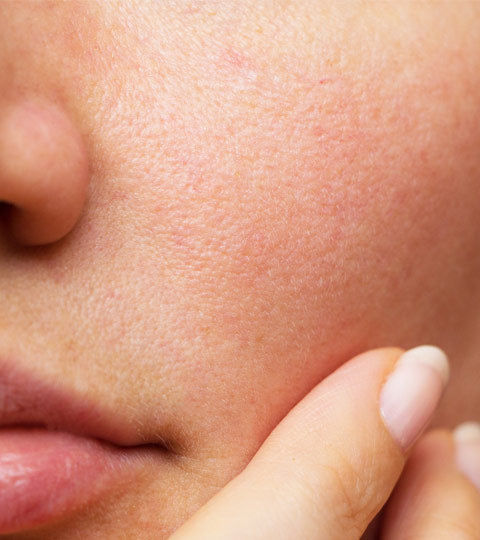 The Ultimate Guide to Treating Large Pores: Tips and Techniques