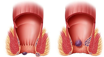 Proctologie