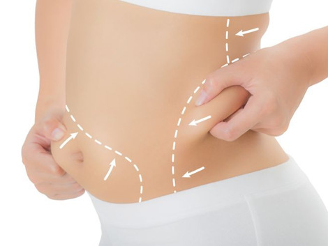 Cost Analysis How Much Does a Tummy Tuck Really Cost in Dubai?