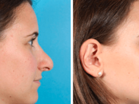 The Rise of Non-Surgical Nose Jobs in Dubai A Comprehensive Guide