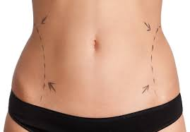 Tummy Tuck vs. Liposuction Which Is Right for You in Dubai?