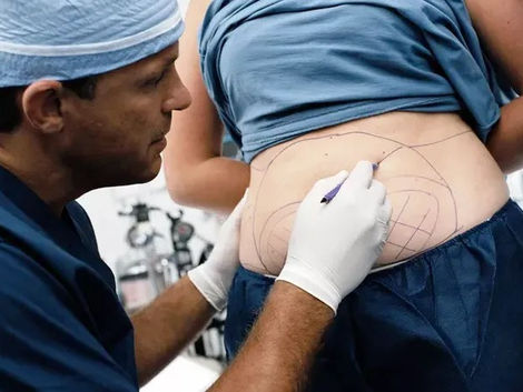 Tummy Tuck vs. Liposuction Which Is Right for You in Dubai?