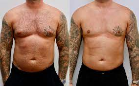 How to Choose the Top Clinics for Gynecomastia Surgery in Dubai Pricing Insights