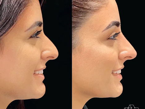 Liquid Rhinoplasty in Dubai: Get the Nose You've Always Dreamed Of