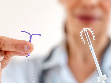 Copper IUD Insertion: Procedure and Benefits in Dubai