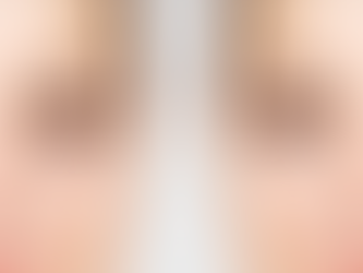 Under Eye Fillers for Dark Circles in Dubai What You Should Know