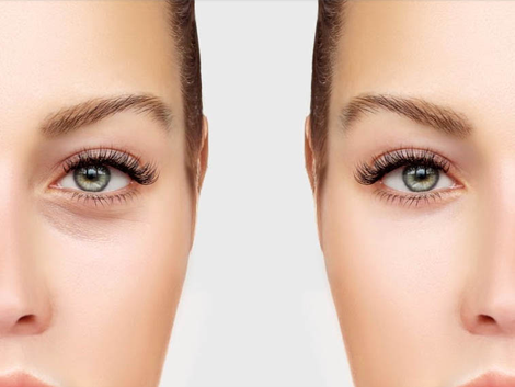 Under Eye Fillers for Dark Circles in Dubai What You Should Know