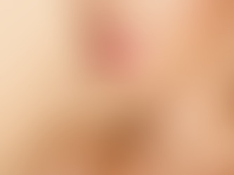 Juvederm Fillers vs. Other Dermal Fillers Choosing the Best Option in Dubai