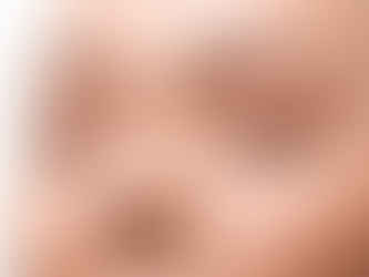 Achieve Your Dream Nose The Benefits of Non-Surgical Rhinoplasty in Dubai
