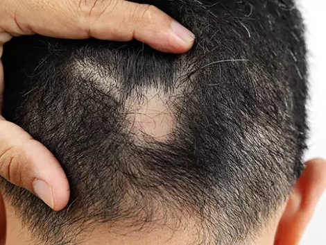 The Complete Guide to Hair Loss Recovery in Dubai From Diagnosis to Treatment