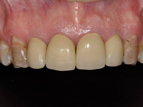 How Much Do Dental Implants Cost in Dubai?