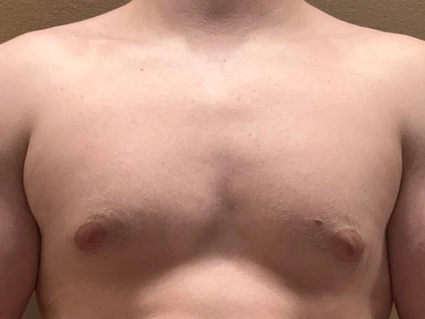 Gynecomastia Surgery in Dubai Price vs. Value
