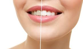 Understanding Teeth Whitening Costs in Dubai What You Need to Know