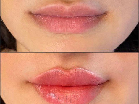 The Russian Lip Filler Trend in Dubai