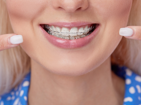 How Much Do Dental Braces Cost in Dubai? A Detailed Overview